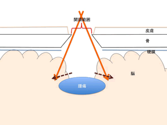 図2 福島式鍵穴手術