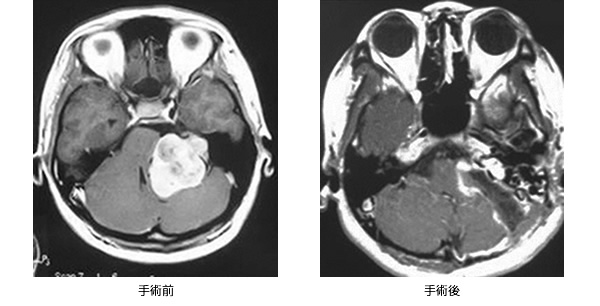 聴神経腫瘍 MRI画像 手術前と手術後