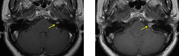 聴神経腫瘍 MRI画像 ガンマナイフ後2年で腫瘍増大