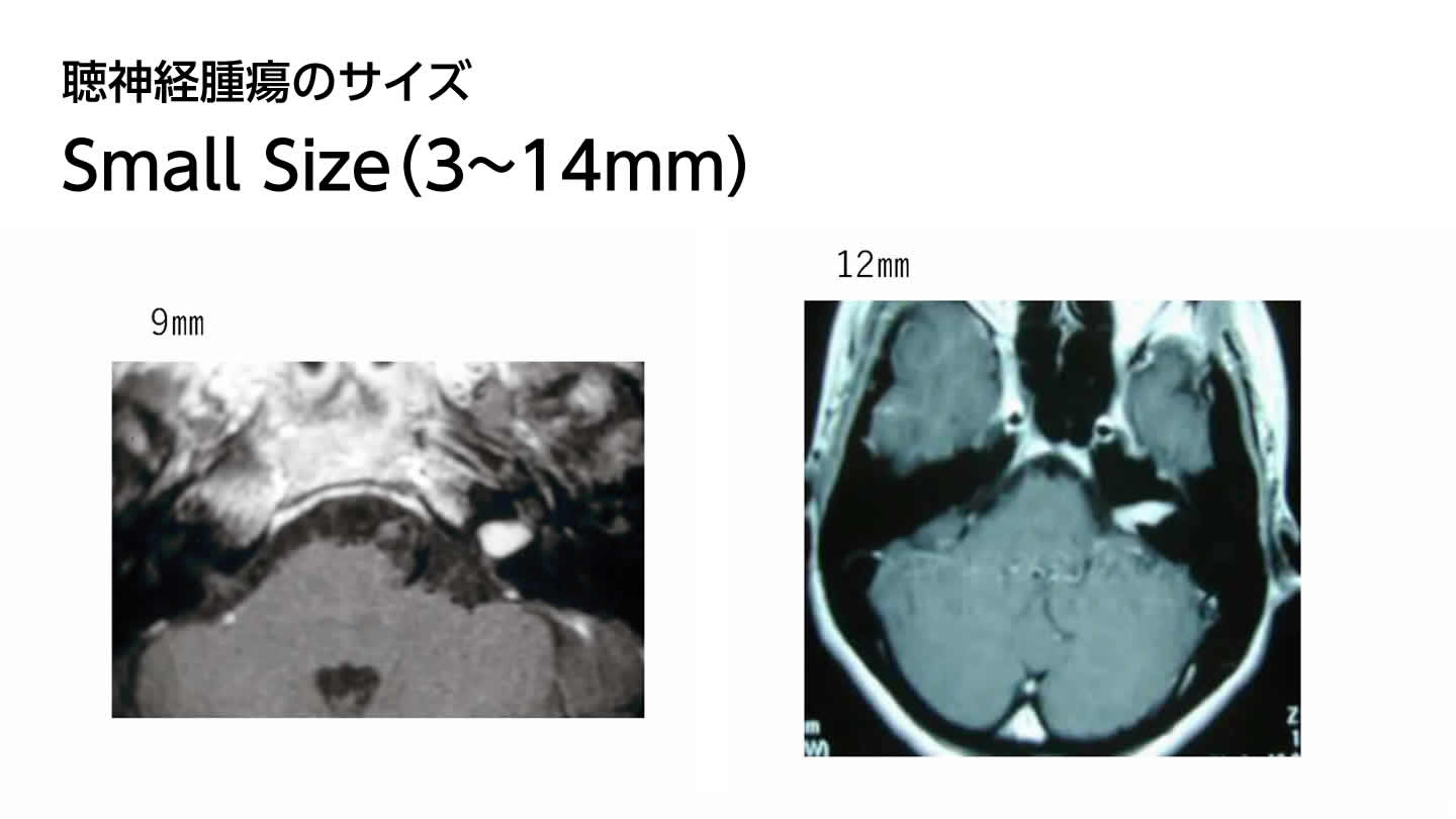 聴神経腫瘍のサイズ　Small Size