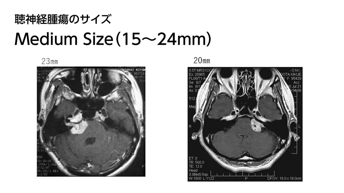 聴神経腫瘍のサイズ  Medium Size