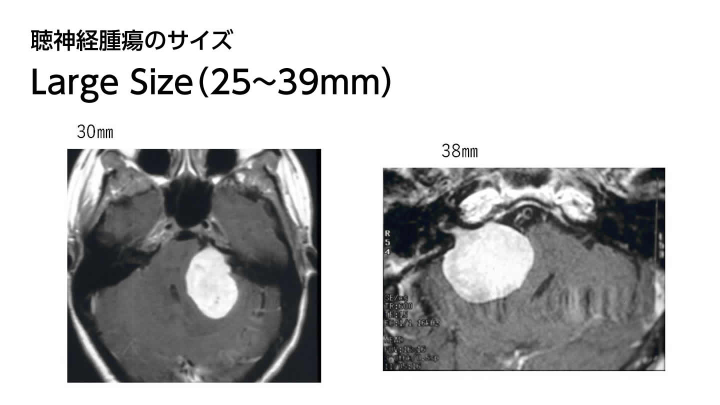 聴神経腫瘍のサイズ  Large Size