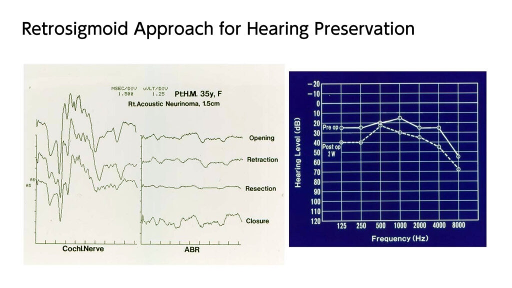 Retrosigmoid Approach for Hearing Preservation