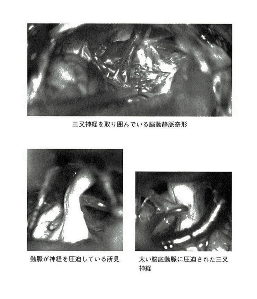 三叉神経を取り囲んでいる脳動静脈奇形／動脈が神経を圧迫している所見／脳底動脈に圧迫された三叉神経