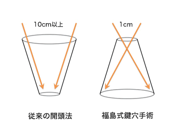 鍵穴手術と従来の回答法の違い