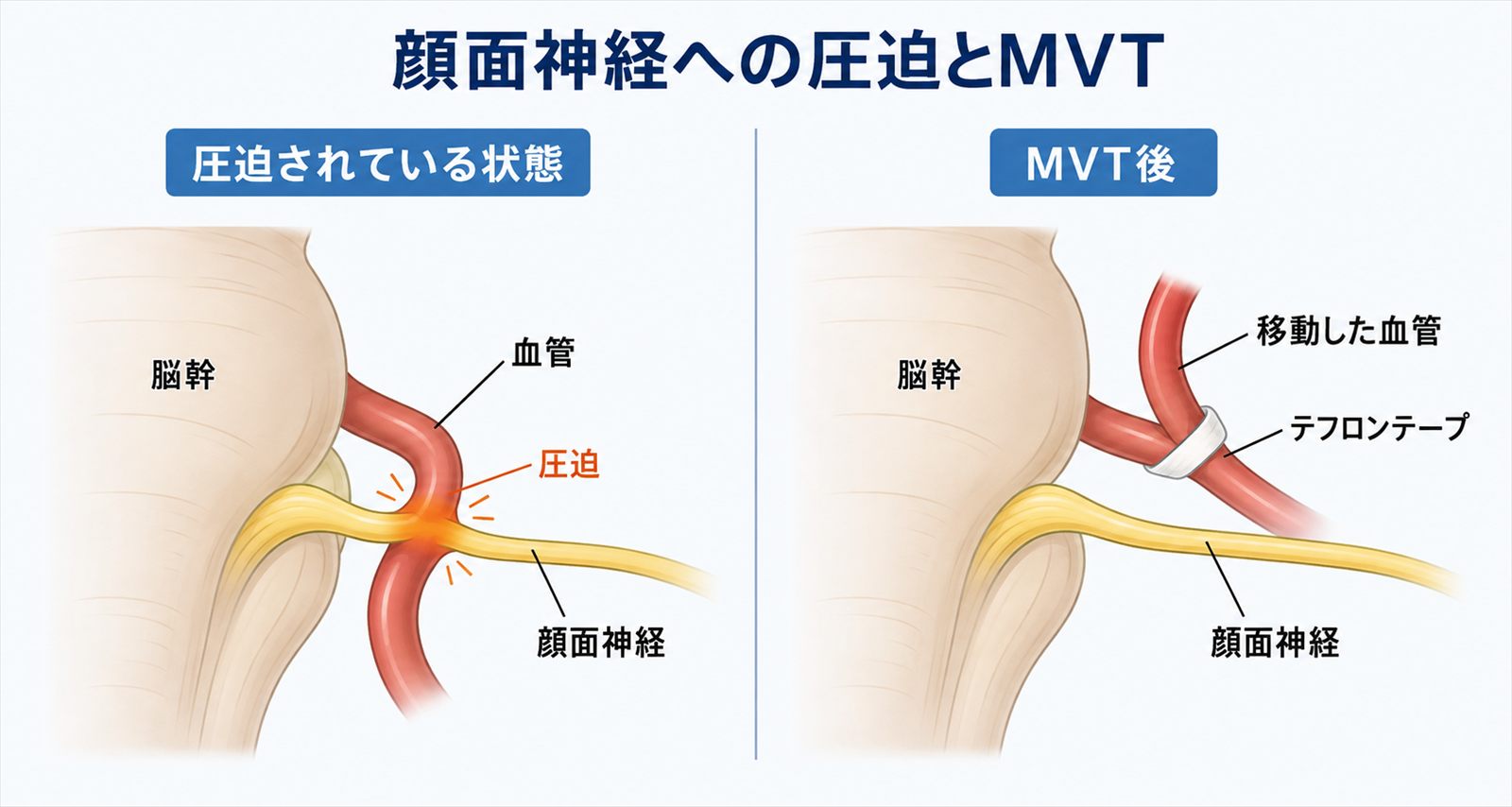 血管が顔面神経を圧迫している状態と、MVTで血管を移動した状態の比較図