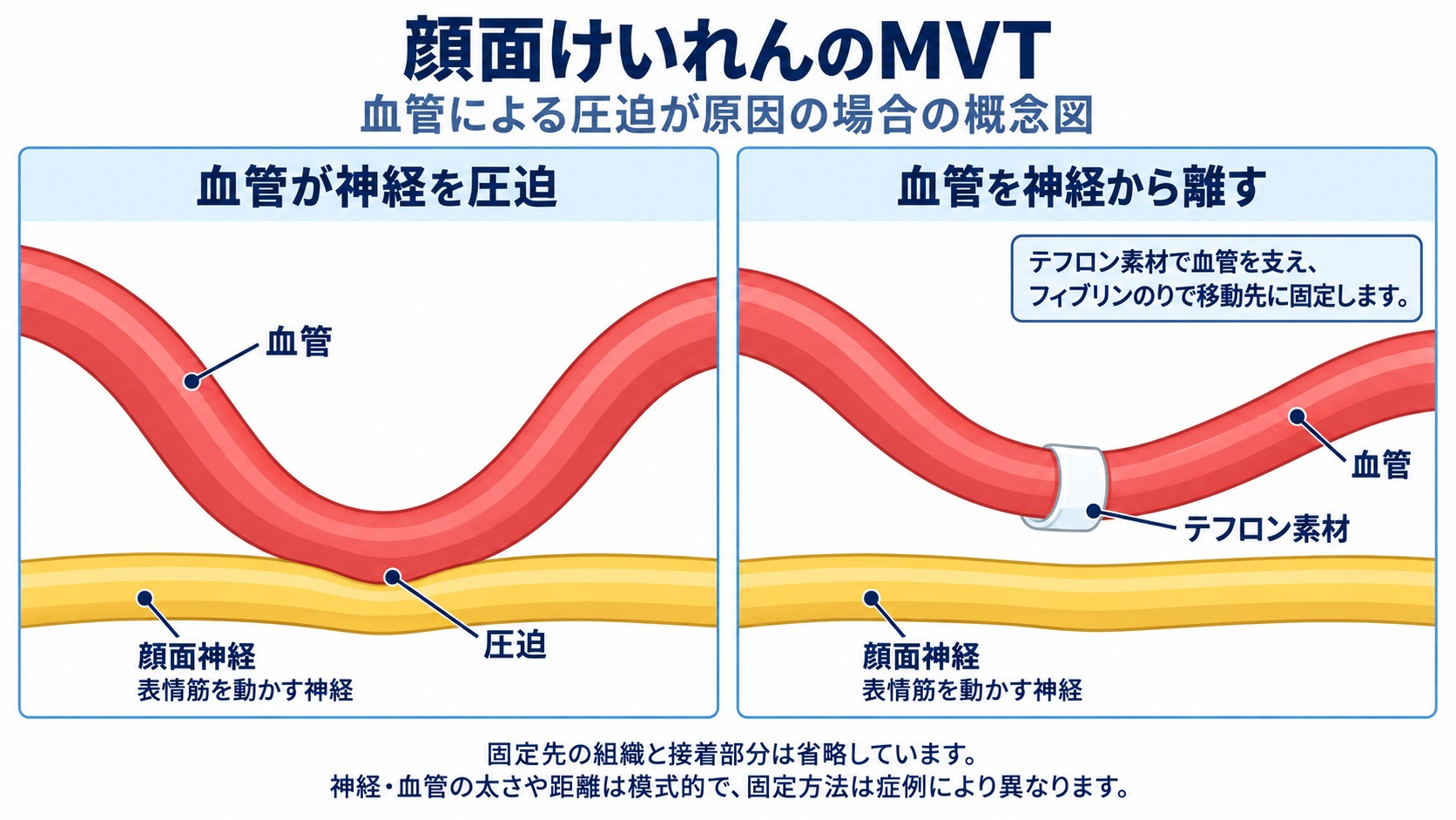 顔面神経を圧迫する血管と、血管を神経から離して固定した状態の概念図