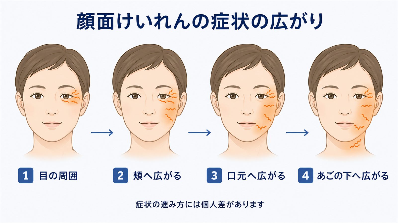 顔面けいれんが目の周囲から頬、口元、あごの下へ広がる一例
