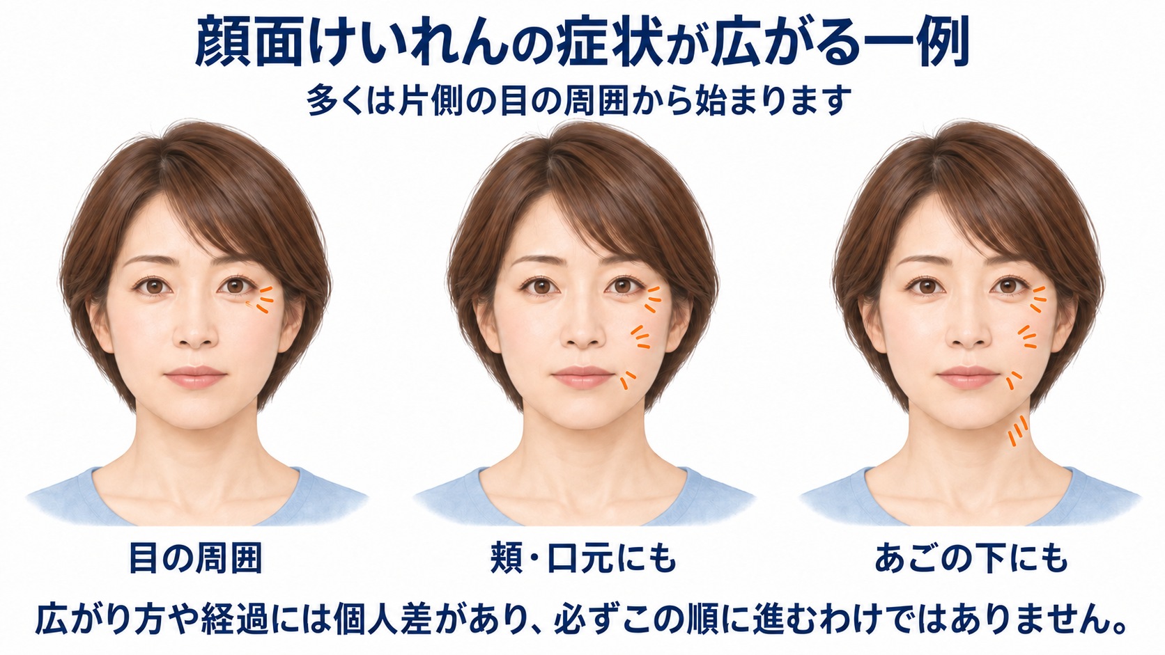 顔面けいれんが片側の目の周囲から頬、口元、あごの下へ広がる一例