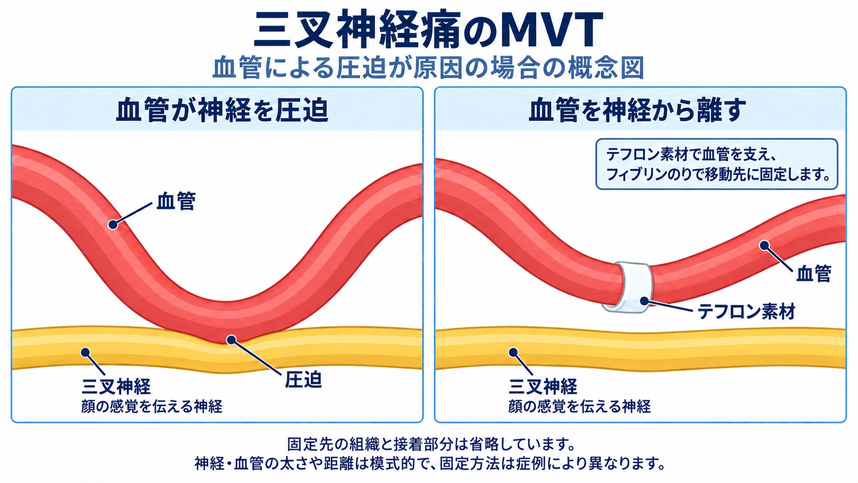 三叉神経を圧迫する血管と、血管を神経から離して固定した状態の概念図