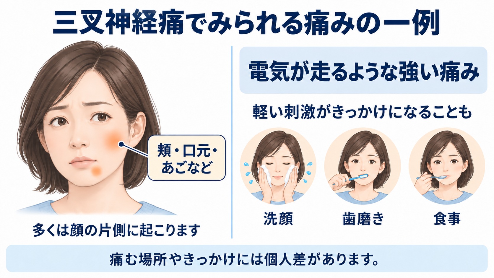 三叉神経痛で頬や口元、あごが痛む一例と、洗顔・歯磨き・食事による誘発の例